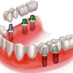 vstavit-zub (1)