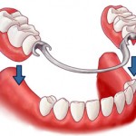 vstavit-zub (2)
