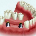 vstavit-zub (4)
